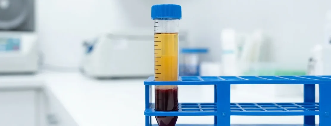 Sertleşme Probleminde Penise PRP (P-Shot) Tedavisi